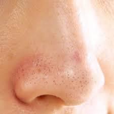 Treating Men’s Nose Blackheads