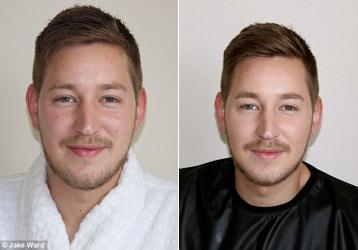 Men’s Skin Problems: Red and Blotchy Skin Cured