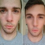 5 Ways To Cover Up Acne Scars