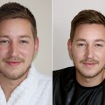Men’s Skin Problems: Red and Blotchy Skin Cured