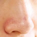 Treating Men’s Nose Blackheads